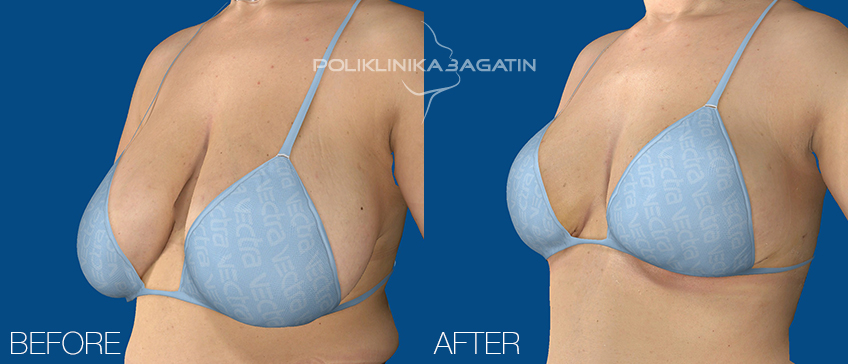 Breast Reduction Surgery 11