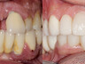 Dental crowns 10