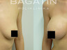 Breast augmentation 13