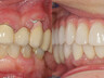 Dental implants 6