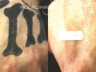 Web_848x364px_Lasersko uklanjanje tetovaža_6_ENG