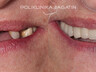 Zubni implantati eng 1