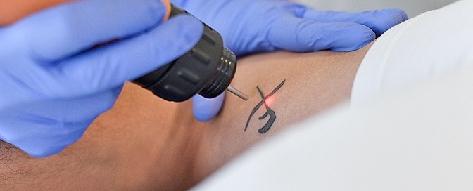 laser tetovaza