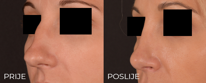 nose surgery experience