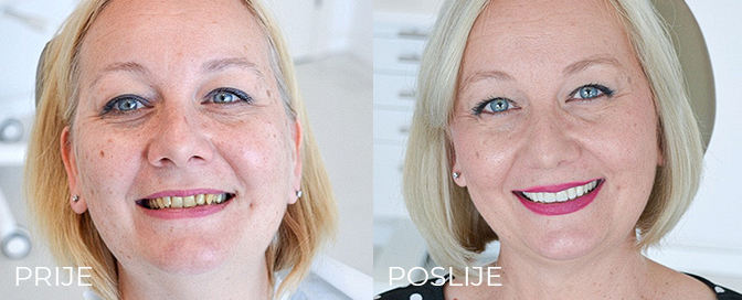 dental implants experience