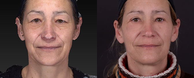 upper eyelid correction