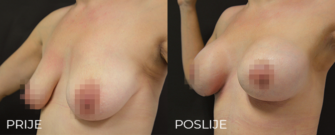 breast lift