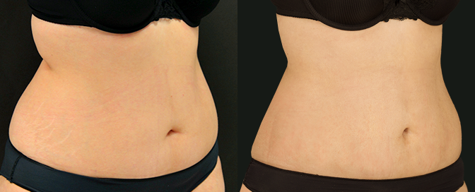liposuction results