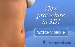 3D animation abdominoplasty