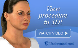3D animation eyelid surgery
