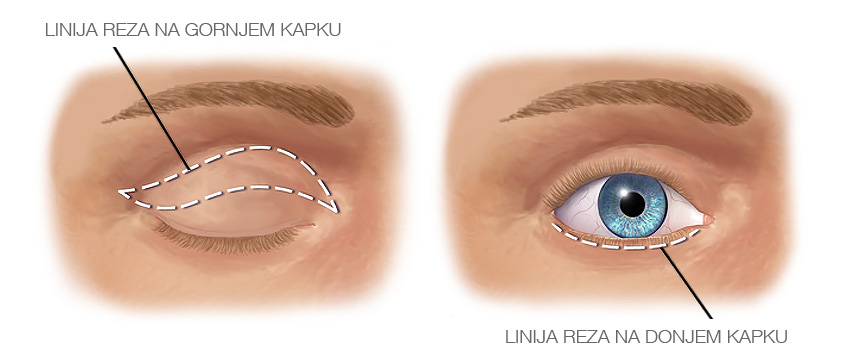 Podizanje kapaka (blefaroplastika)