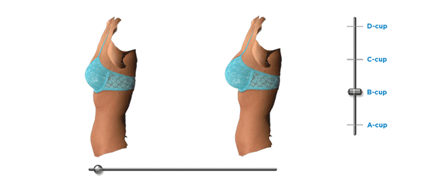 VECTRA XT 3D svetovanja za dojke
