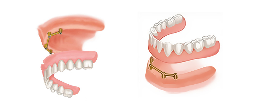 Dentures over implants