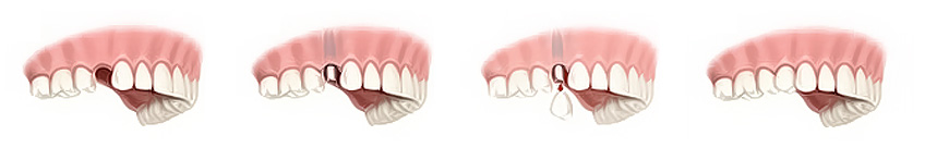 Jedan zub na implantatu