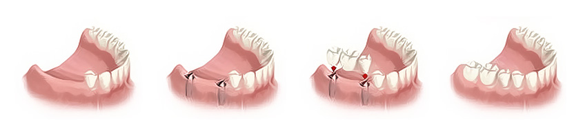 Mali most na implantatima