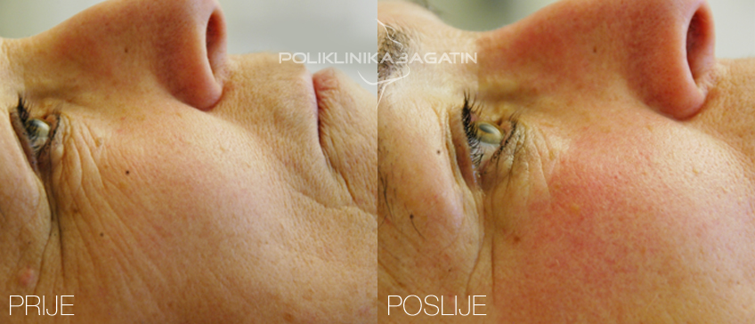 Med Visage tretman