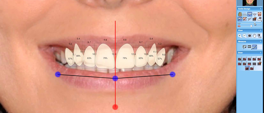 Planmeca Smile Design – system for planning a dream smile