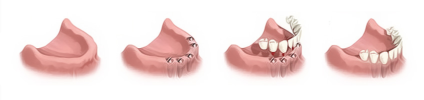 Semicircular bridge on implants