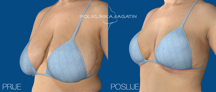 Breast reduction