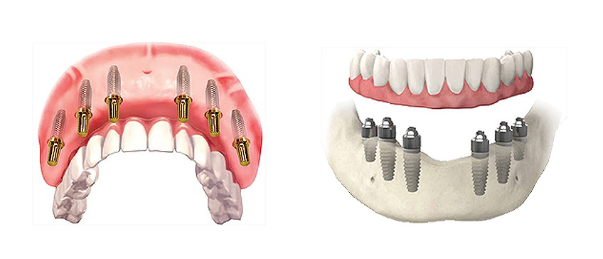 Types of teeth implants