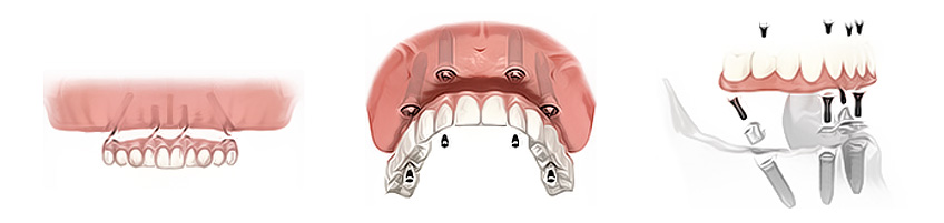 Types of teeth implants