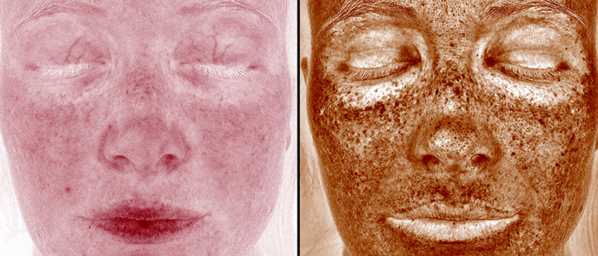 VISIA profesionalna analiza kože lica