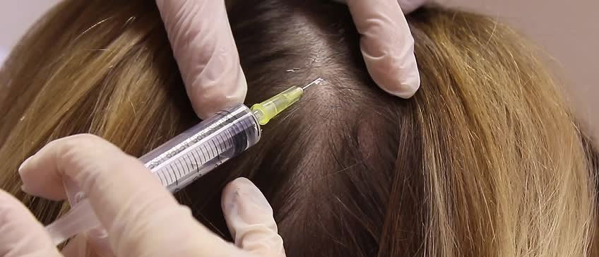 Ponovni rast kose uz PRP terapiju