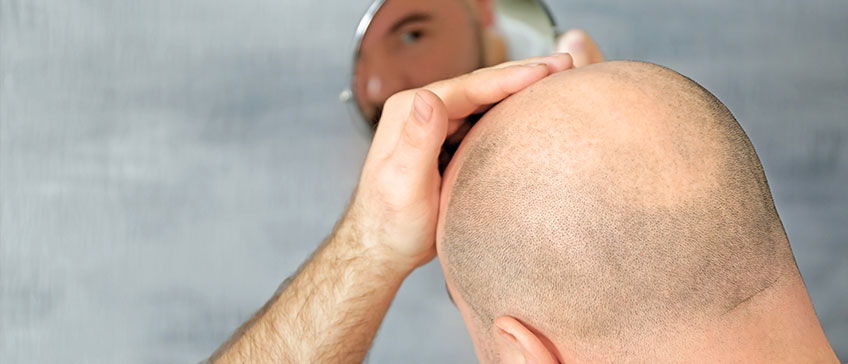 alopecija