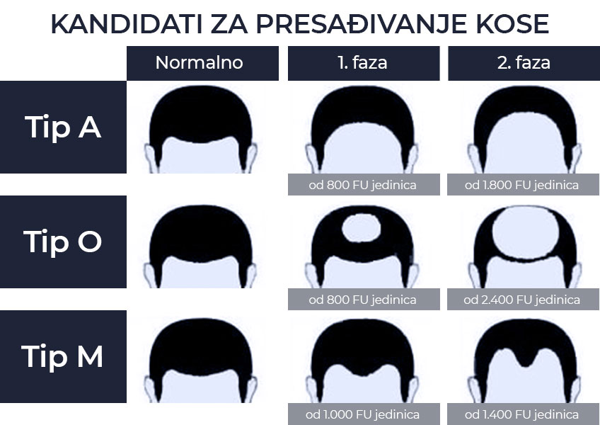 presađivanje kose