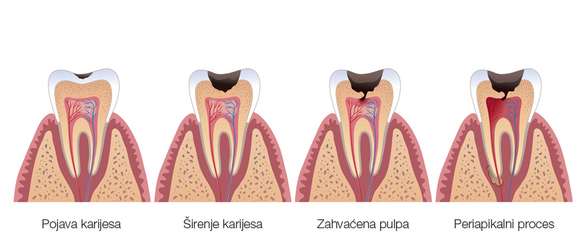 Uklonite Karijes Pomocu Lasera Uz Manji Osjecaj Boli