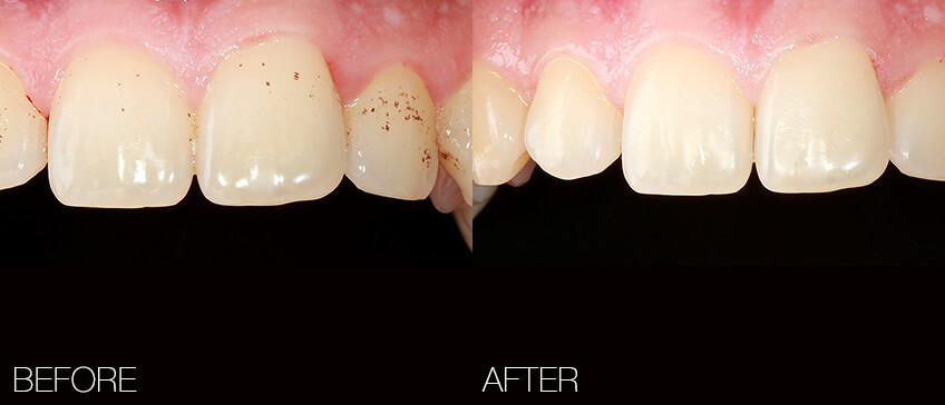 Dental calculus removal and sandblasting