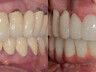 Zahnkronen und Zahnbrücken 1