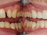 Zahnkronen und Zahnbrücken 2
