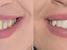 Zahnkronen und Zahnbrücken 3