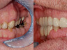 Zahnkronen und Zahnbrücken 5