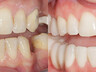 Dental crowns 12