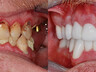 Dental crowns 15