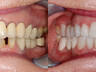 Dental crowns 16