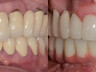 Dental crowns 9