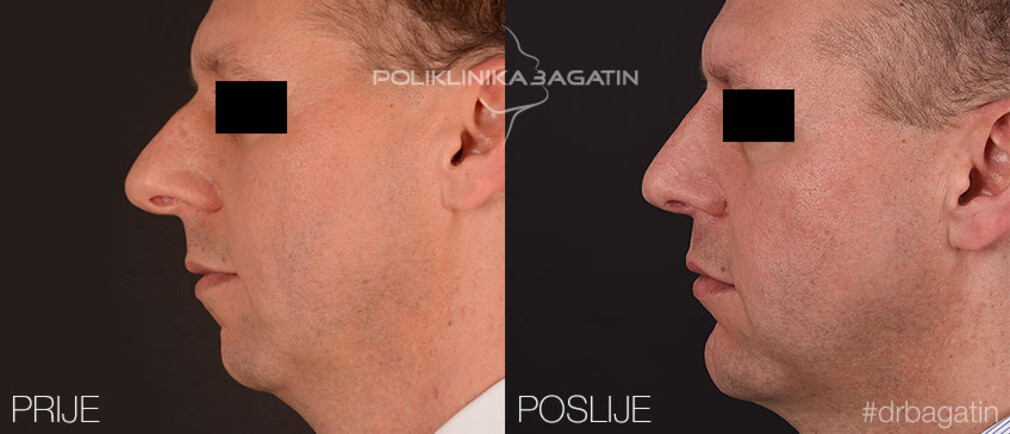 Rinoplastika Poliklinika Bagatin