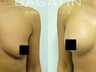 Breast augmentation 1