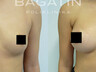 Breast augmentation 12