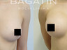 Breast augmentation 14