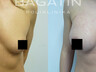 Breast augmentation 15