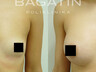 Breast augmentation 16