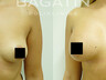 Breast augmentation 17