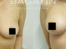 Breast augmentation 19