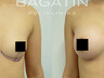 Breast augmentation 2