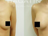 Breast augmentation 22