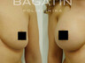 Breast augmentation 23